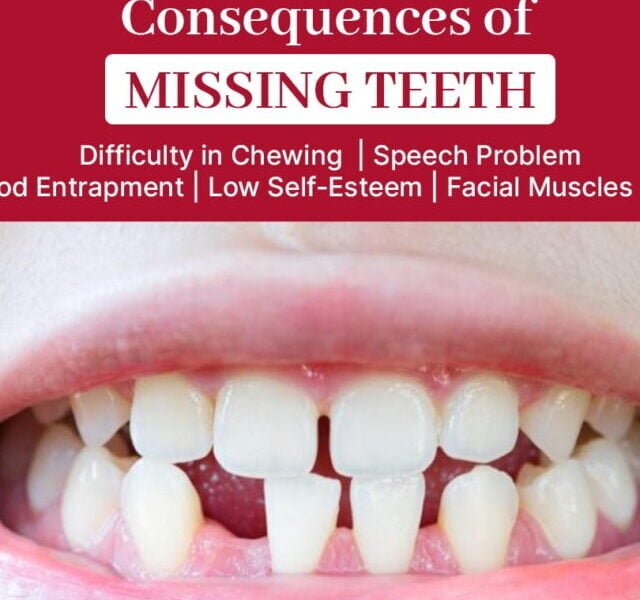 Permanent Solution for Missing Teeth with Dental Implants – Restore Your Smile and Oral Health