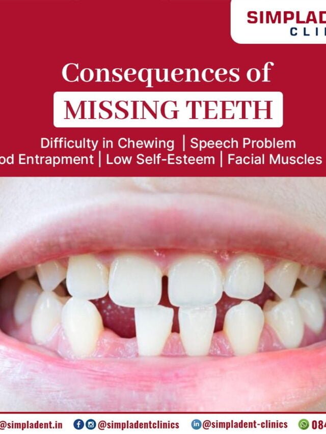 Transform Your Smile with Dental Implant Treatment: The Permanent Solution for Missing Teeth