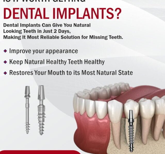 Discover the Value: Dental Implants Worth Every Penny