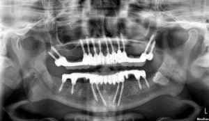 Tooth implant procedure