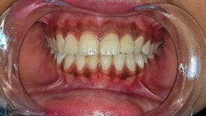 Teeth implants clinic in india