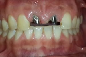 BASAL IMPLANTS