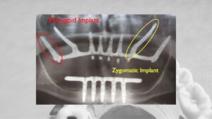 ZYGOMATIC-IMPLANTS