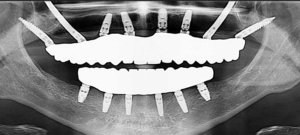 Zygomatic Dental Implants