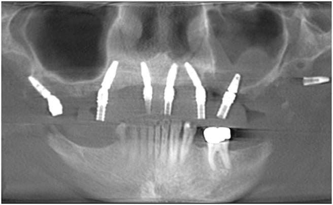 Pterygoid Implants