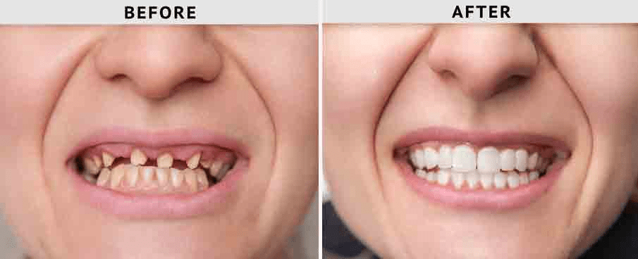 Full Mouth Dental Implants