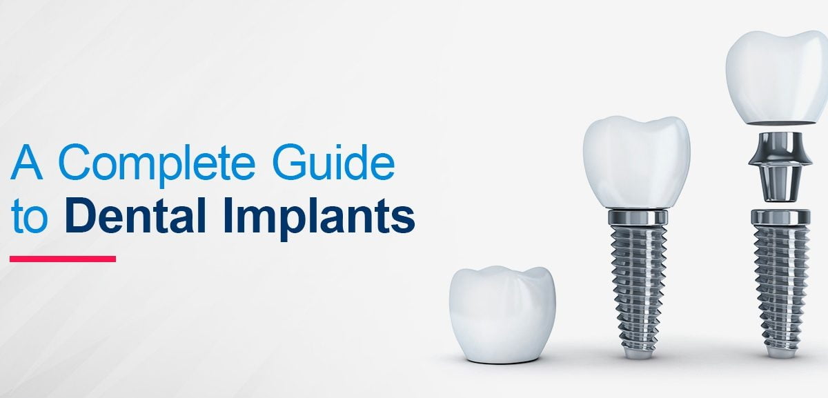 Understanding Immediate Loading Dental Implants