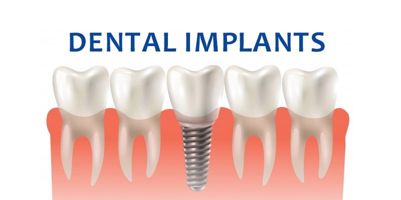 Understanding Immediate Loading Dental Implants