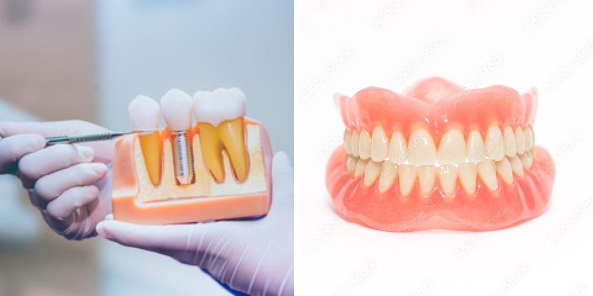 Dental Implants