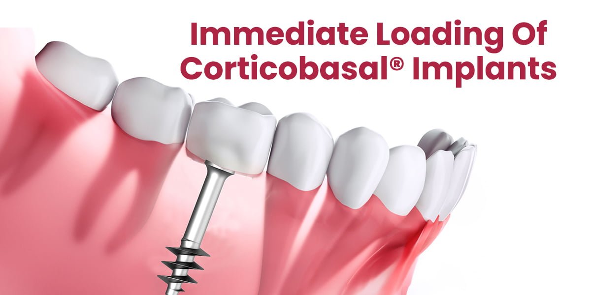 Immediate Loading of Corticobasal Implants, dental implants, quick dental restoration, advanced dental technology