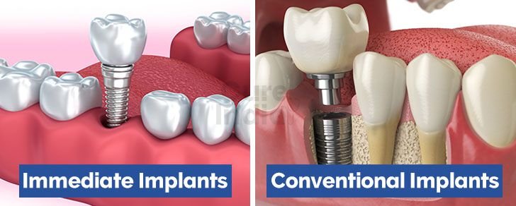 Immediate Loading Vs. Traditional Implants - Simpladent Clinics