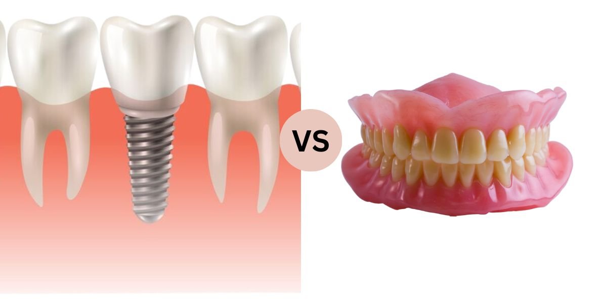 Corticobasal Immediate Loading Implants vs Dentures Comparison