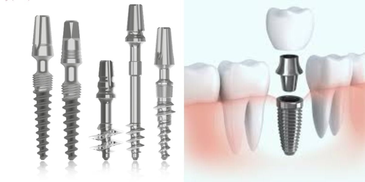 Immediate Loading vs. Traditional Dental Implants