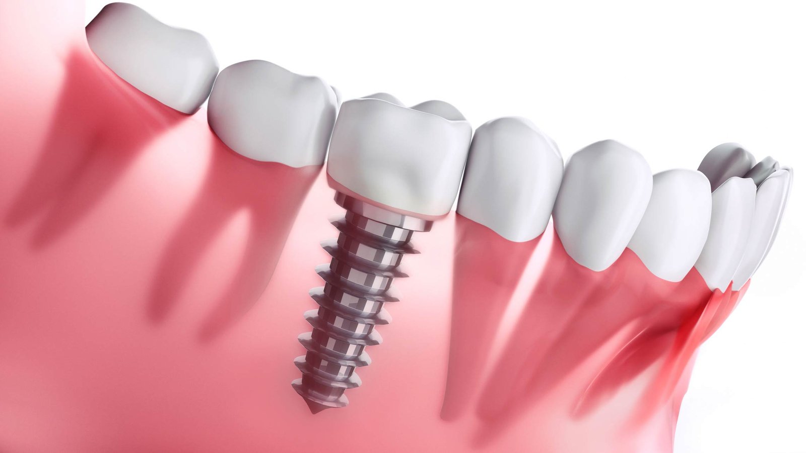 The Benefits of Immediate Loading Implants