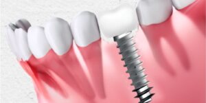 Basal Dental Implants