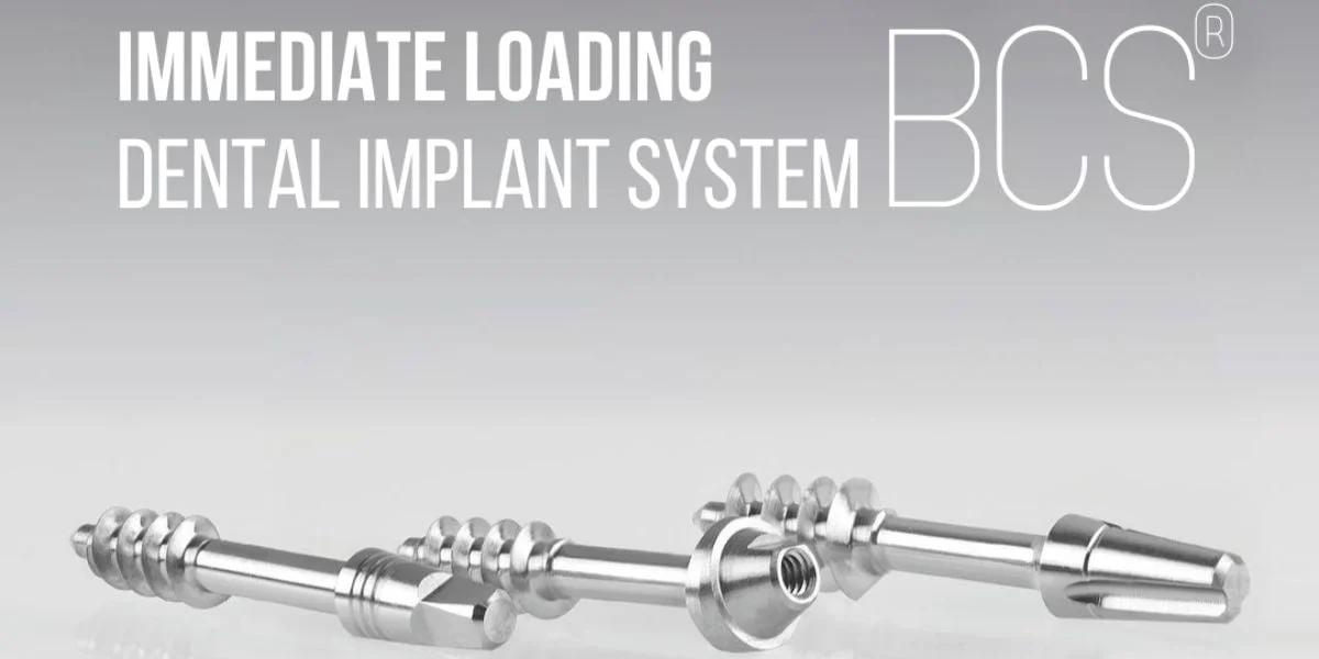 Understanding Immediate Loading Dental Implants