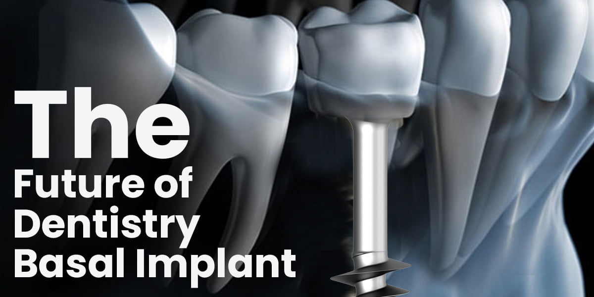 Basal Implants procedure, advanced dental technology, low bone density solution, long-lasting dental implants, expert dental restoration.