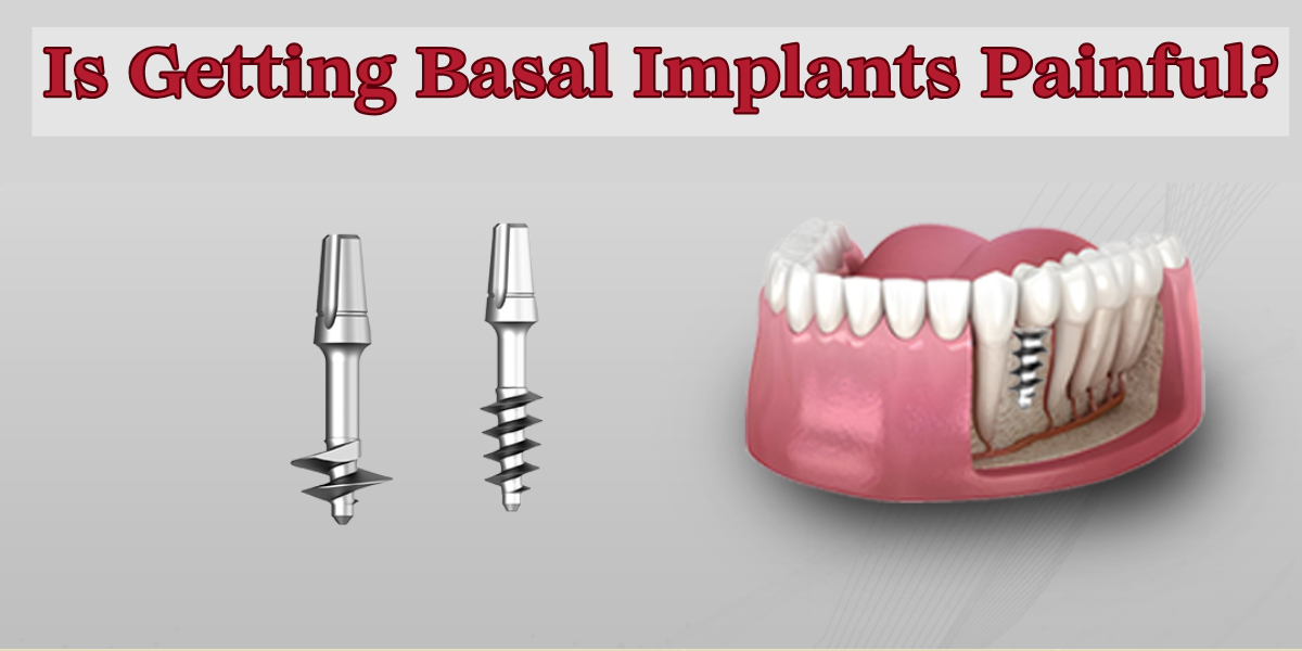 Is Getting Basal Implants Painful? What You Should Know